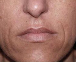 Secret RF Before & After Patient #1620